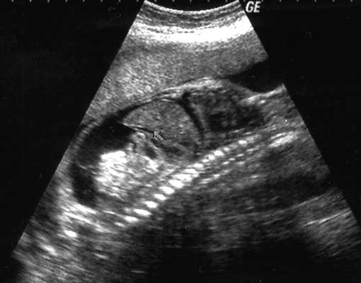 Порок сердца у плода при беременности: диагностическое УЗИ, причины и лечение