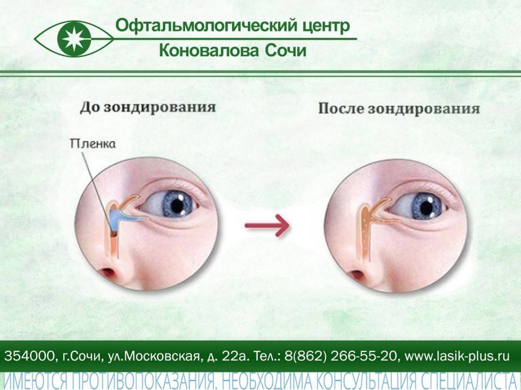 Лечение гнойных выделений из глаз у ребенка (желтоватого или белого цвета) в москве