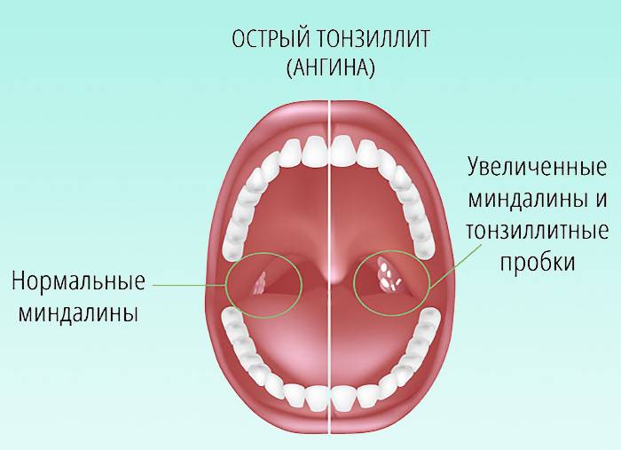 Схема лечения ангины