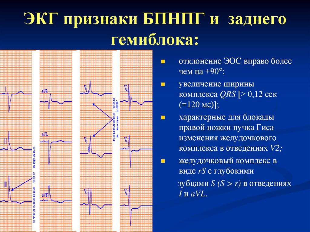 Нбпнпг на экг: что это такое, причины неполной блокады правой ножки пучка гиса