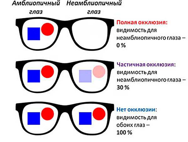 Амблиопия или «ленивый глаз»/детские заболевания - «глазцентр» — микрохирургия глаза в ульяновске
