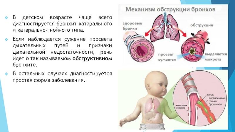Обструктивный бронхит у детей - симптомы болезни, профилактика и лечение обструктивного бронхита у детей, причины заболевания и его диагностика на eurolab