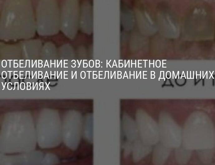 Отбеливание зубов: классификация, виды и возможные проблемы