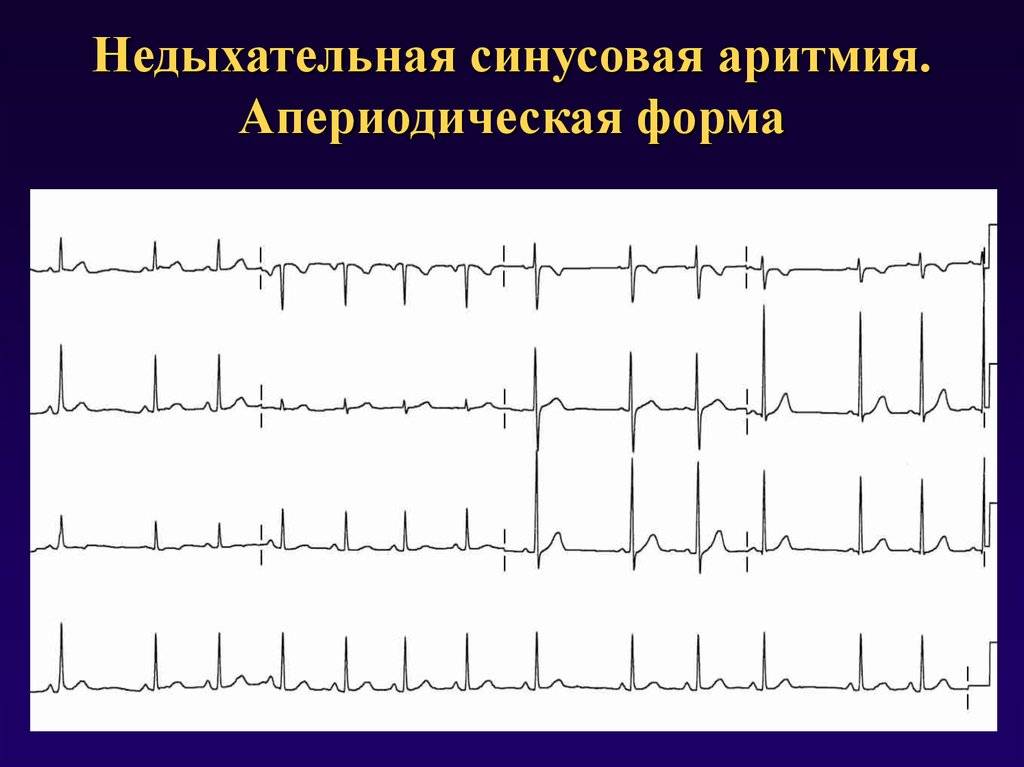 Что значит синусовый ритм сердца на экг. Синусовая аритмия на ЭКГ. Синусовая аритмия ЭКГ признаки. Дыхательная и недыхательная синусовая аритмия на ЭКГ. Кардиограмма сердца синусовой аритмия у ребенка.