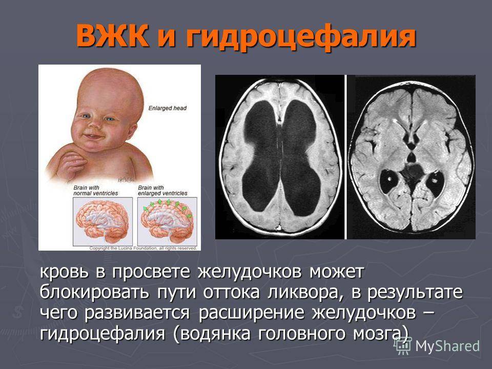 Расширение желудочков головного мозга у новорожденных