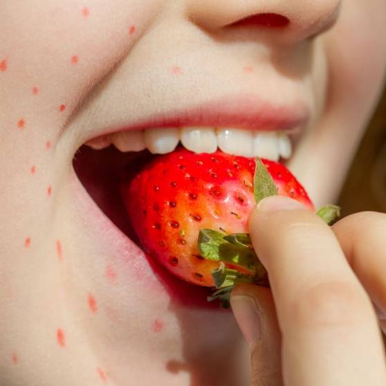 Аллергия на клубнику у ребенка: фото, симптомы, реакция на другие ягоды