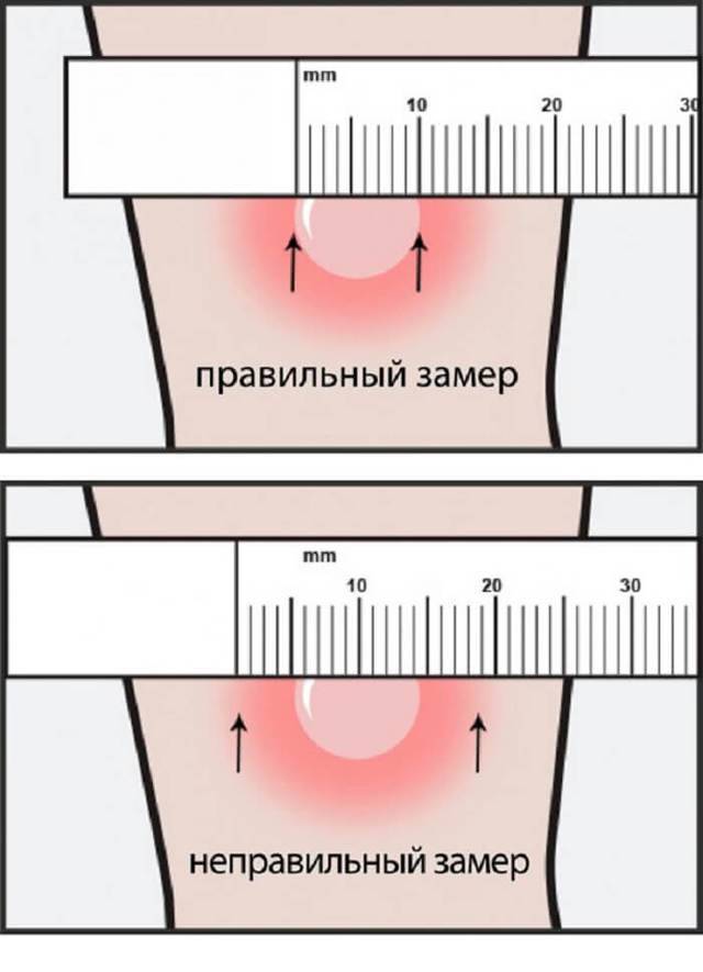 Проба Манту: оценка результата у детей, нормы в таблице, подготовка к прививке, расшифровка реакции