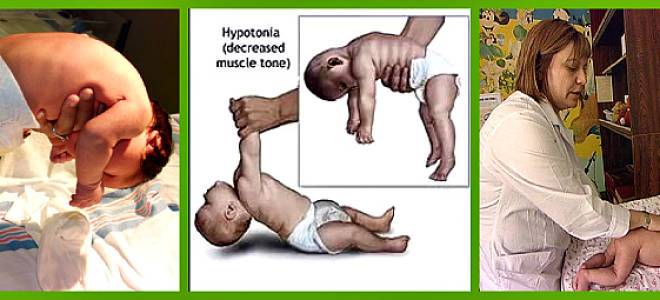 Лечение гипертонуса мышц у детей, восстановление у доктора никонова