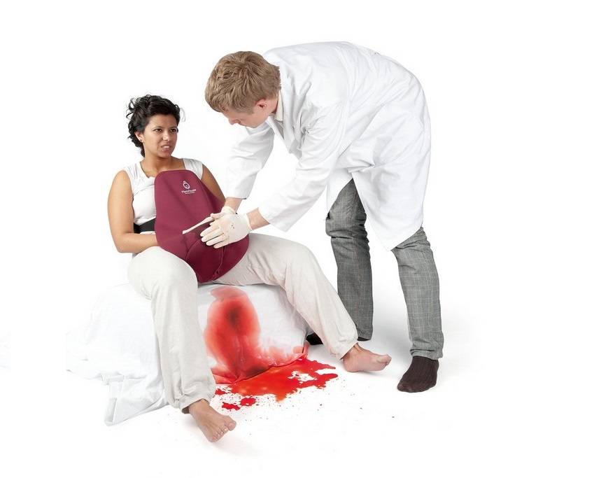 Маточное кровотечение - диагностика, лечение, профилактика | медицинский дом odrex