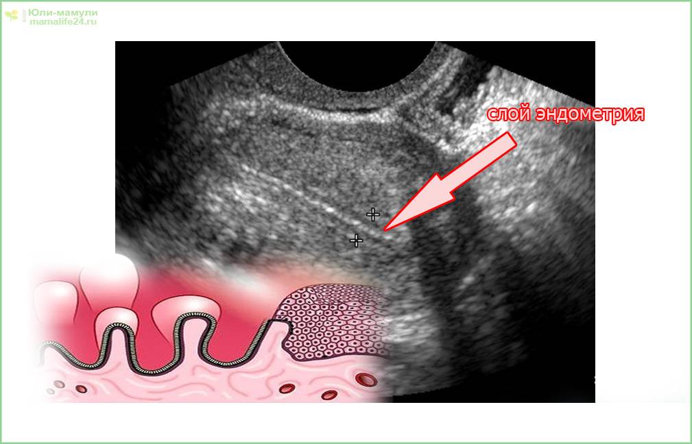 Тонкий эндометрий - как причина бесплодия. можно ли забеременеть при гипоплазии эндометрия с помощью эко