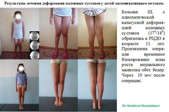 Артроз коленных суставов (гонартроз) — симптомы и лечение