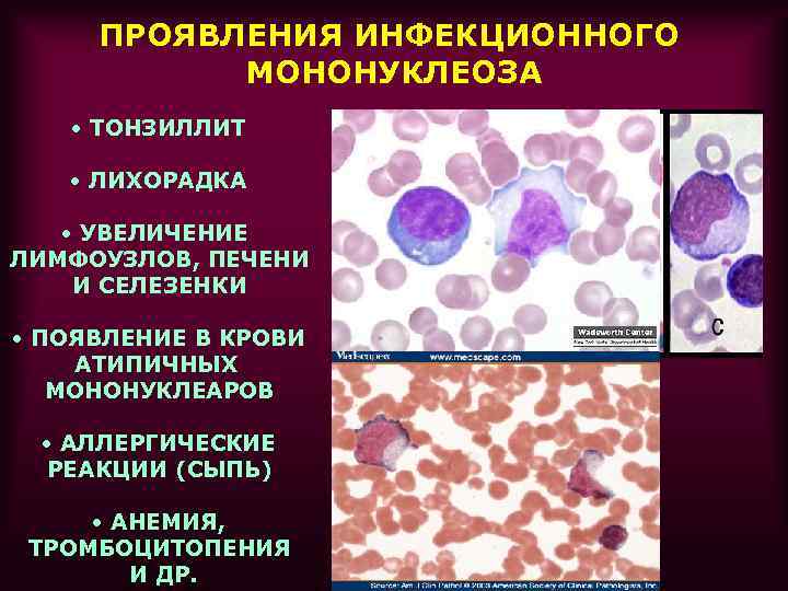 Атипичные мононуклеары в общем анализе крови инвитро
