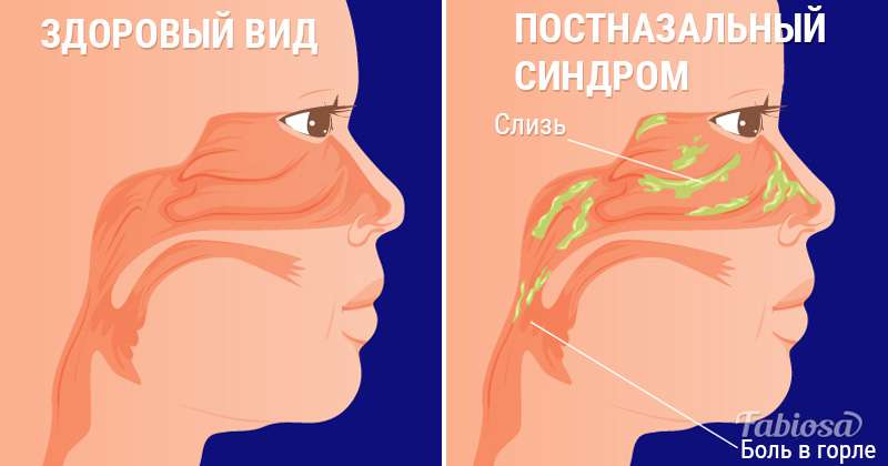 Лобный синусит (фронтит): что это и как лечить?