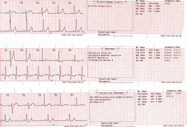Электро кардиограмма в долгопрудном, результаты кардиограммы сердца и описание сердечного ритма