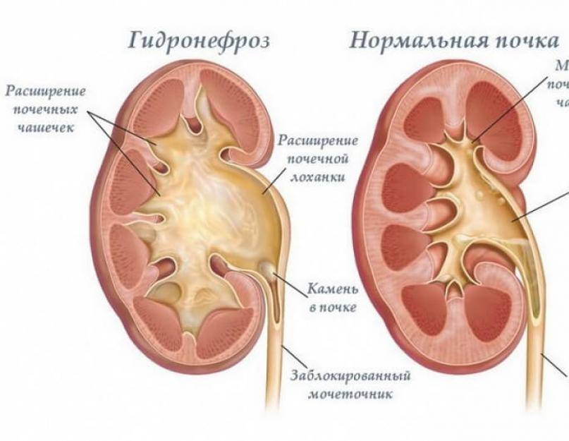 Увеличена почка