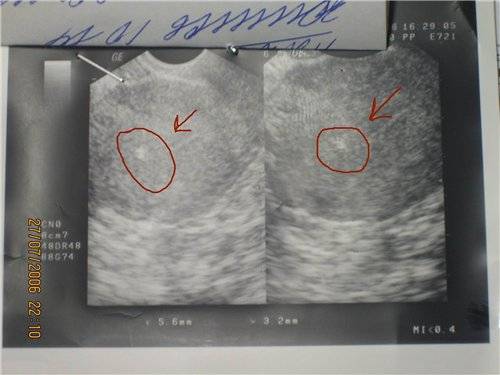 Узи киста же может ли быть беременность - вопрос гинекологу - 03 онлайн