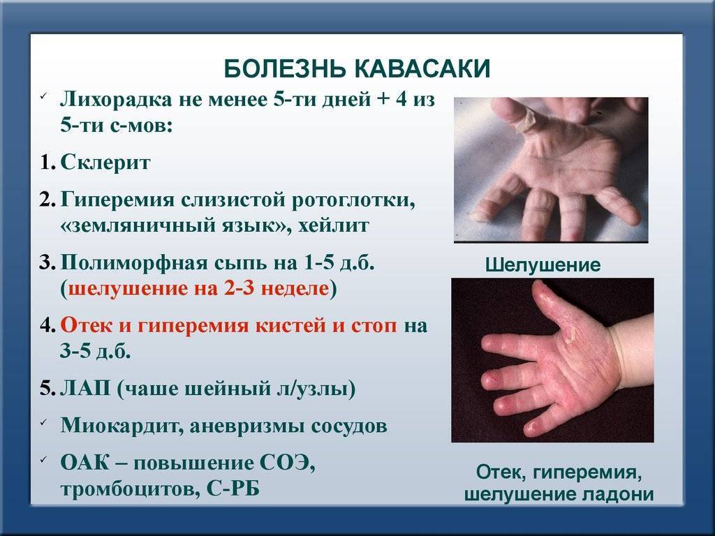 Неврологические заболевания у детей