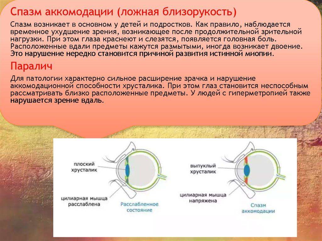 Ложная и истинная близорукость — в чем разница?
