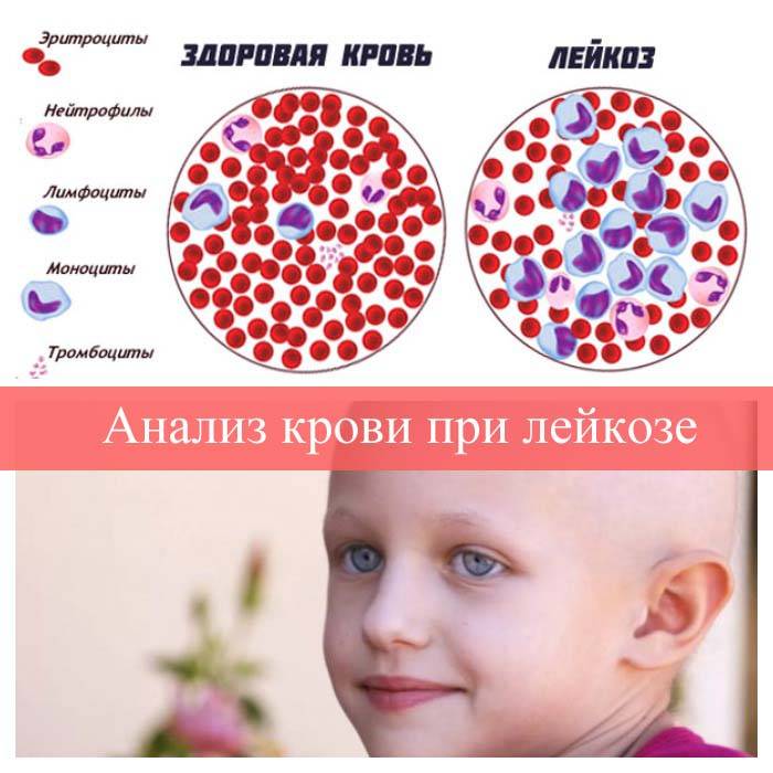 Первые признаки крови у детей. Анализ крови при лейкозе. Кровь при острых лейкозах. Лейкоз симптомы у детей симптомы.