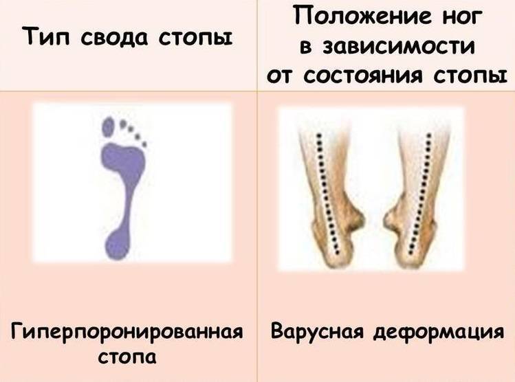 Выпрямление ног - исправление о-образной кривизны (варусной деформации) в москве