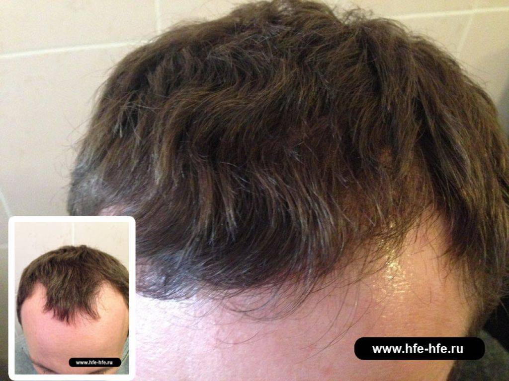 Выпадение волос у мужчин лечение. Андрогенная алопеция алопеция. Андрогенетическая алопеция волосы. Андрогензависимая алопеция. Андрогенной алопеция у мужчин.