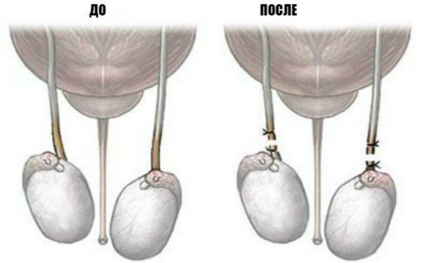 Вазэктомия что это. Хирургическая стерилизация вазэктомия. Бесскальпельная вазэктомия. Перевязывание семенных канатиков.