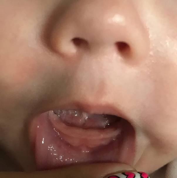 У трехмесячного ребенка текут слюни пузырями и кулак во рту | yurys.ru