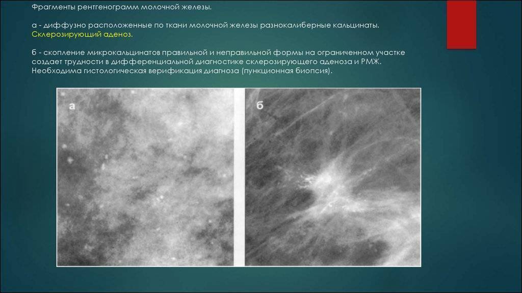 Узловая мастопатия молочной железы что это такое фото