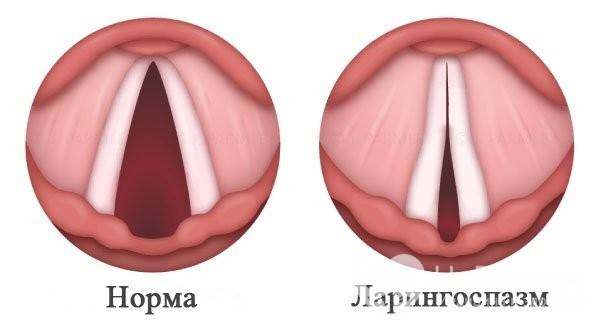 Помощи при острыом стенозирующем ларинготрахеите у ребенка