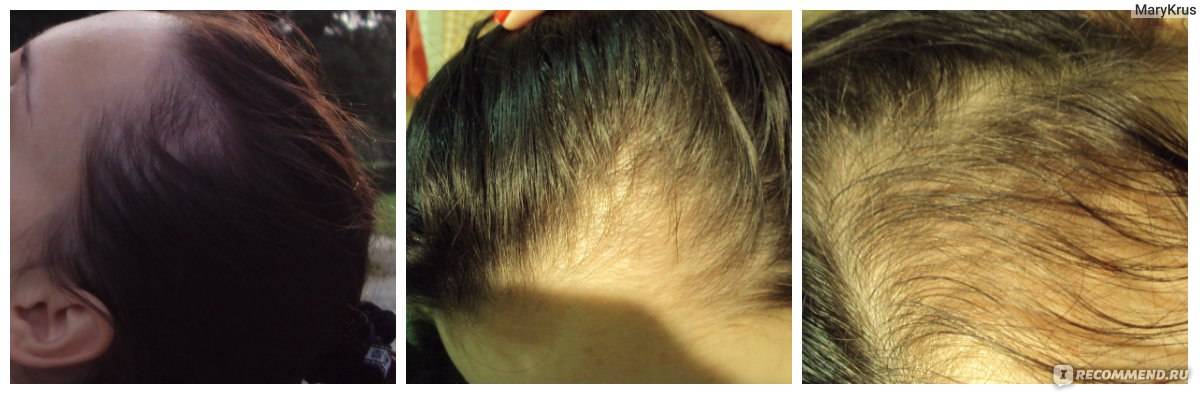 Выпадение волос при беременности: причины, лечение, профилактика