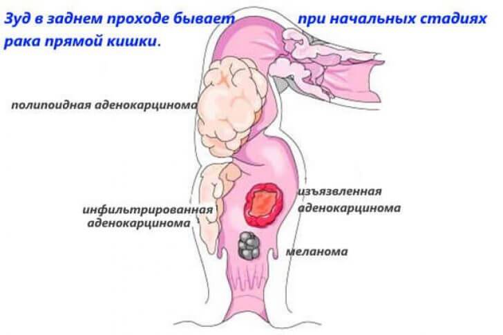 Зуд между ягодицами: лечение, диагностика, причины