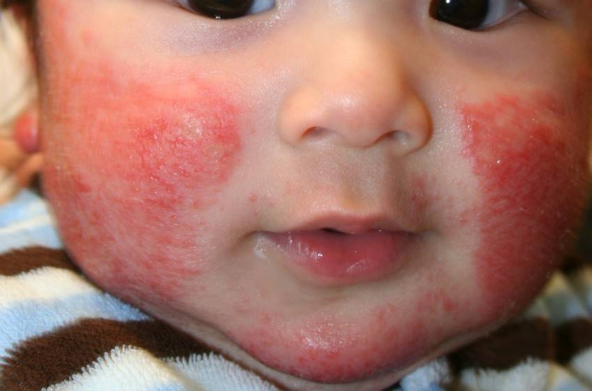 Аллергическая сыпь на лекарства у ребенка фото