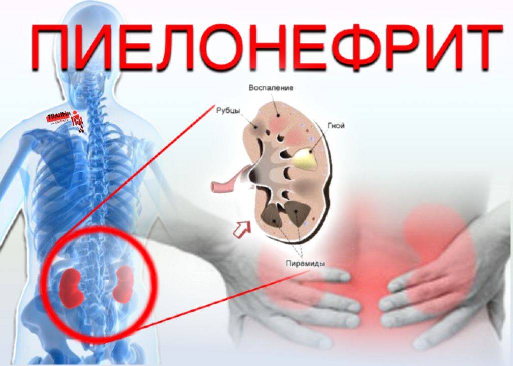 Профилактика хронического пиелонефрита
