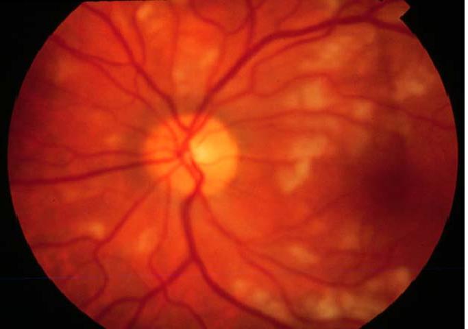 Гипертоническая ангиопатия обоих глаз. Ангиопатия сетчатки глазное дно. Атеросклеротическая ретинопатия. Гипертоническая ретинопатия офтальмоскопия. Ангиопатия и ретинопатия сетчатки.