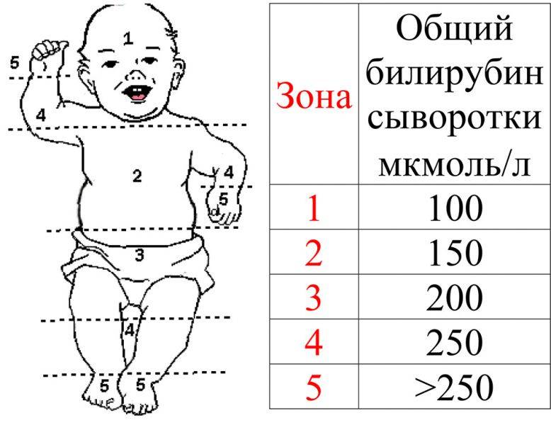 Детская желтуха – лечение, причины и последствия