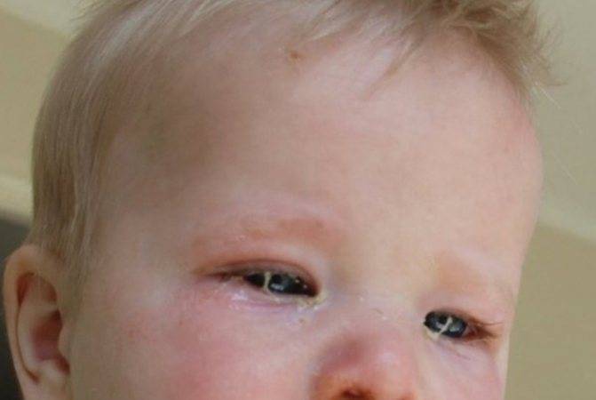 Конъюнктивит у грудничка, младенца до года: причины и признаки воспаления глаз у детей, как лечить грудного ребенка, фото