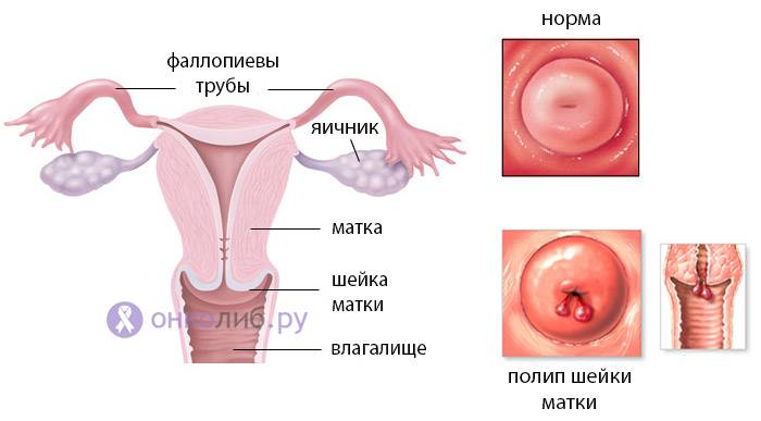 За сколько до месячных опускается шейка матки. изменения в матке в период менструации