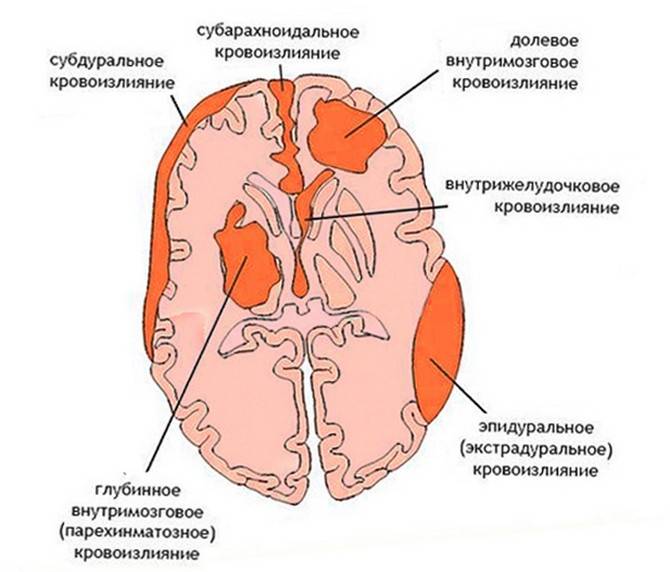 Геморрагический инсульт