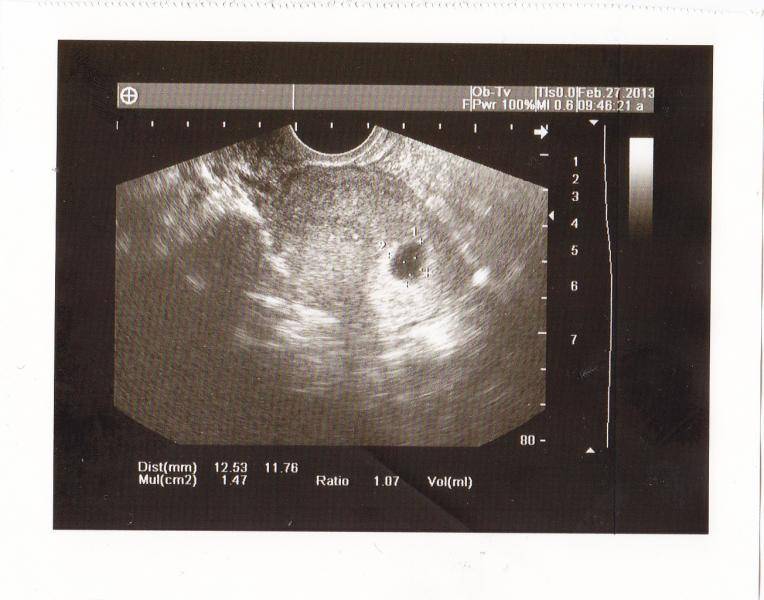 Многоплодная беременность: признаки на ранних сроках, на каком можно определить двойню, фото и когда видно на узи