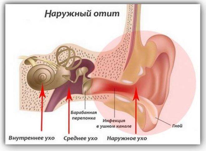 Лечение отита, симптомы хронического воспаления острого среднего уха у взрослых, лекарства