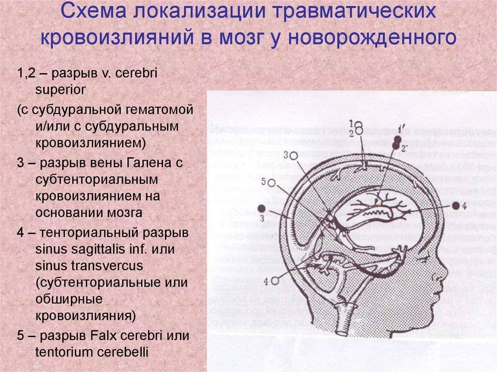 Кровоизлияние в мозг у новорожденных