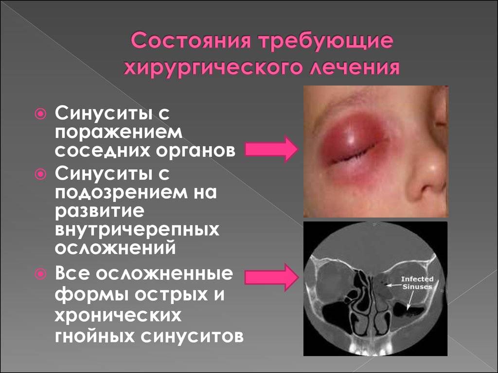 Хронический синусит (хронический риносинусит) - эффективные методики лечения