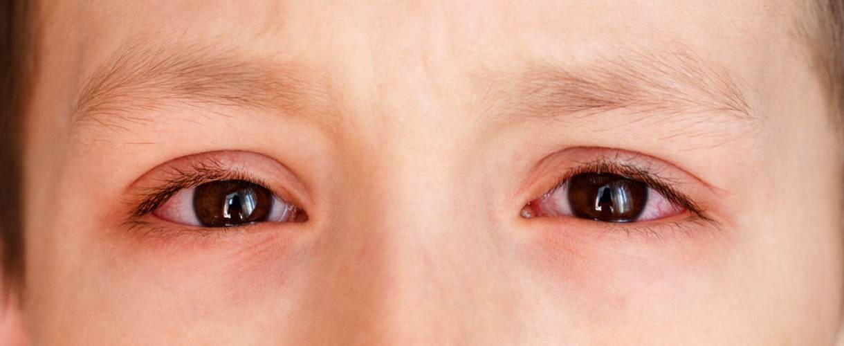 Причины аллергической реакции глаз