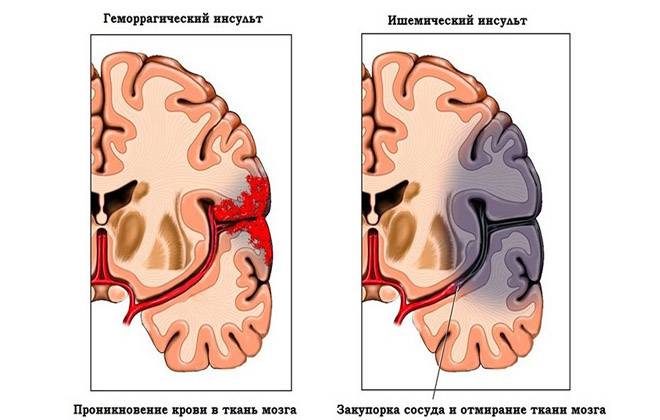 Субарахноидальное кровоизлияние