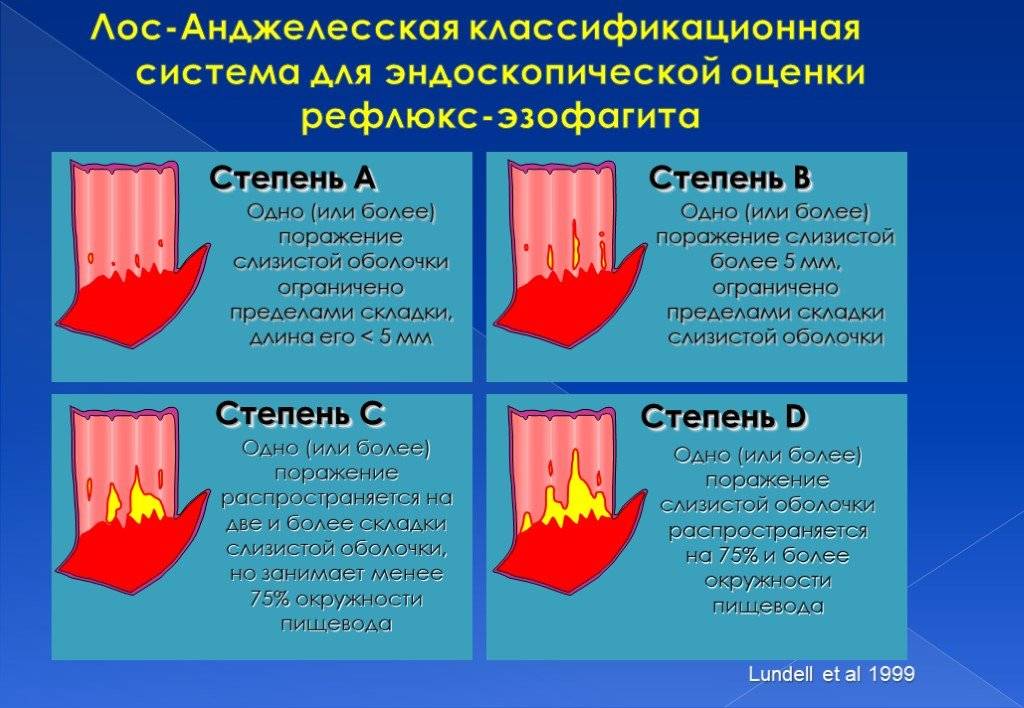 Лос анджелесская классификация эзофагитов