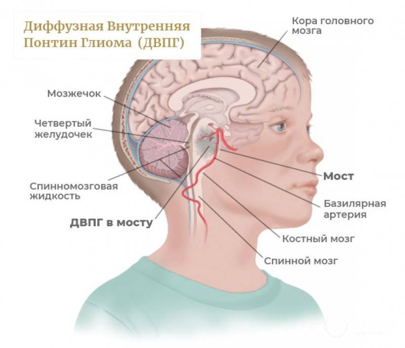 Виды опухолей мозга у детей