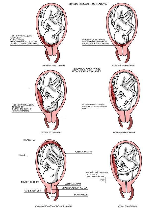 Размер живота при беременности: зависит ли от прикрепления плаценты по передней или задней стенке
