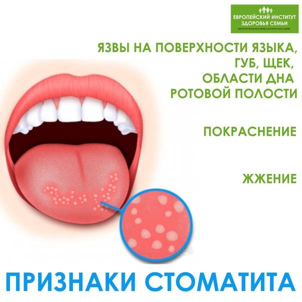 Лечение кандидозного стоматита у взрослых и детей: препараты, симптомы