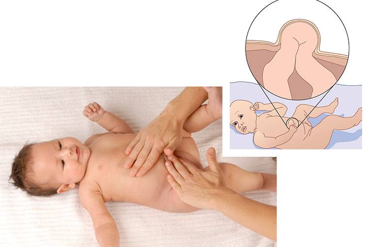 Пупочная грыжа у новорожденных (Комаровский): массаж, видео