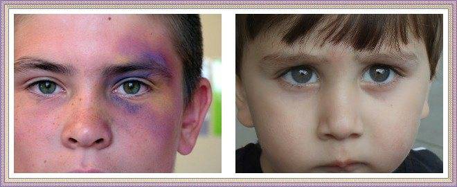 Почему у ребенка появляются синяки под глазами: причины и способы лечения